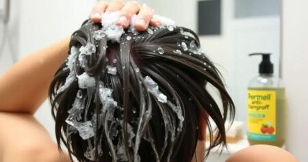 Caspa: Causas, Prevenção e Tratamentos Naturais